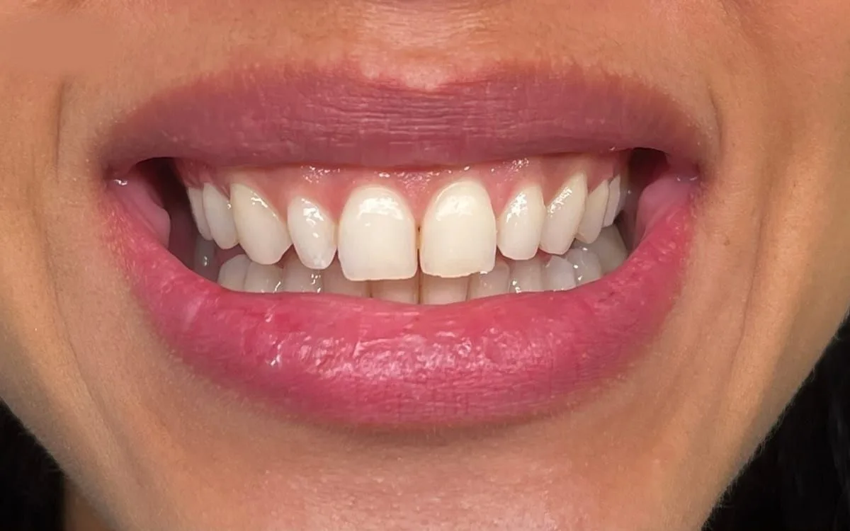 Antes e depois de facetas em resina