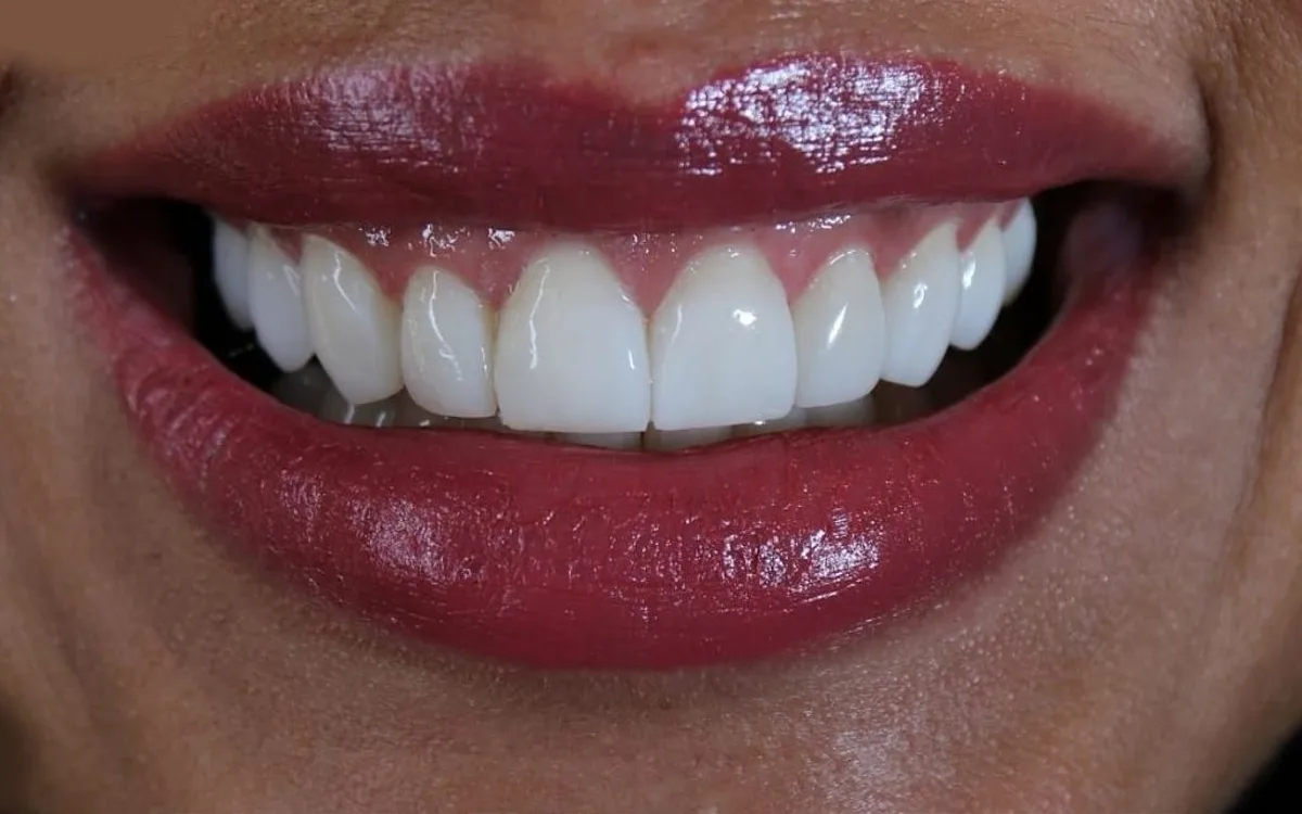 Antes e depois de facetas em resina