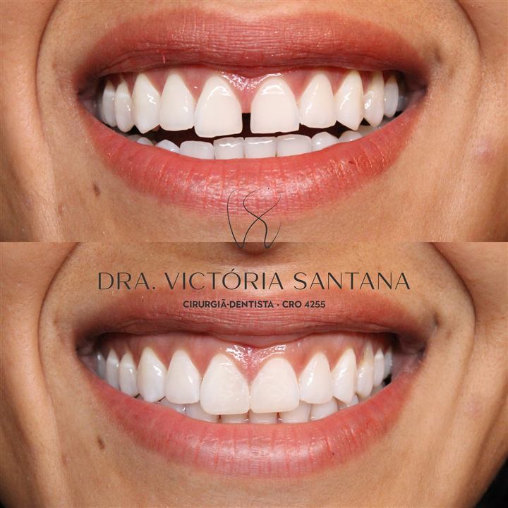 Fechamento de diastema
