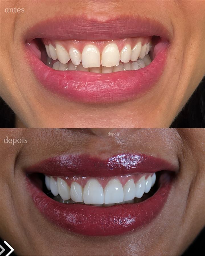 Antes e depois do sorriso