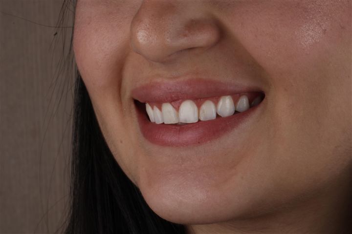 Resultado natural em close