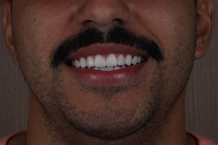 Facetas em resina