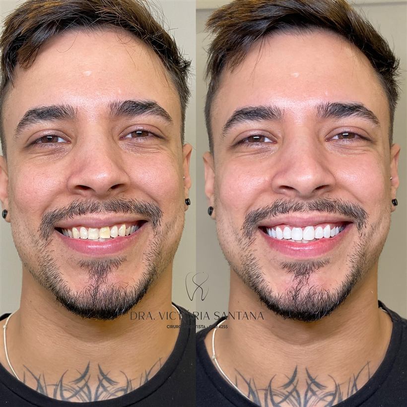 Facetas em resina, antes e depois de paciente