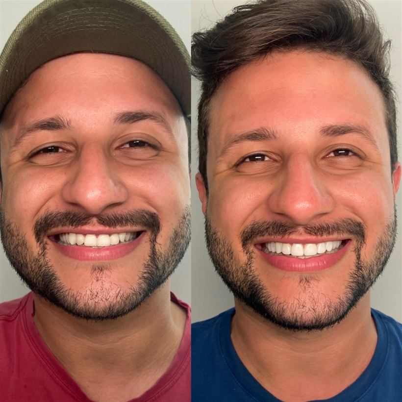Sorriso transformado com facetas
