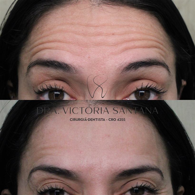 Harmonizacao orofacial, toxina botulinica antes e depois