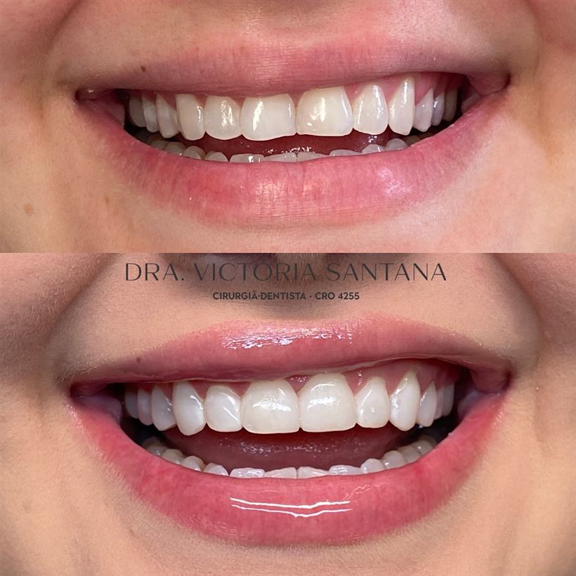 Facetas em resina composta