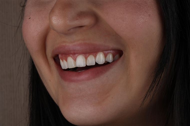 Facetas em resina composta