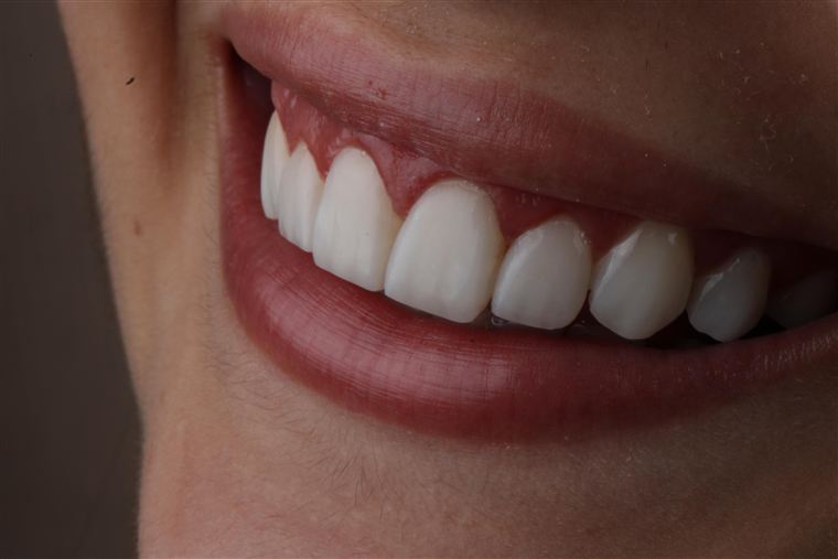 Clareamento dental, sorriso branco natural