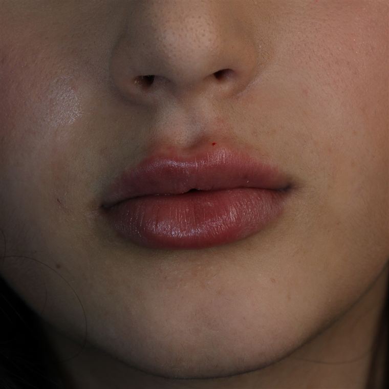 Preenchimento labial, harmonização orofacial