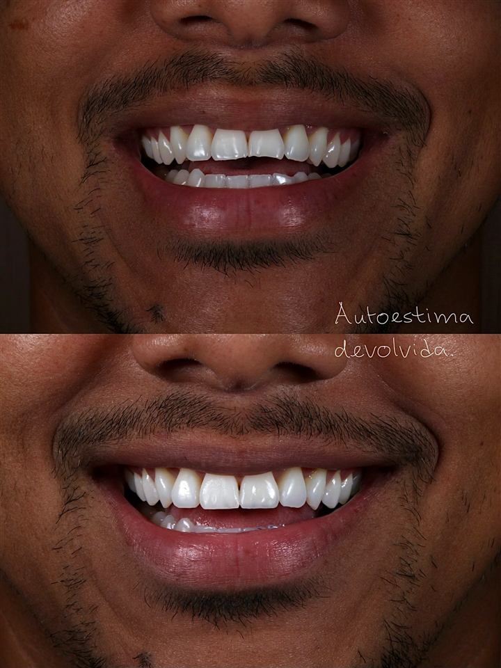 Facetas em resina composta, antes e depois